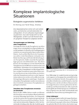 Aktuelles: Komplexe Implantologische Situationen