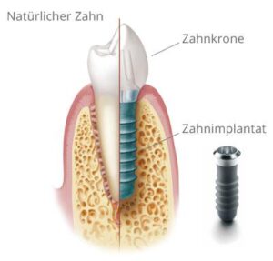 Grafik eines Zahnimplantats mit Beschriftung