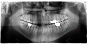Röntgenbild eines Kiefers mit entzündeter Wurzelspitze vor einer mikrochirurgischen Wurzelspitzenresektion