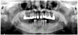 Darstellung eines Röntgenbilds mit einer Kieferzyste mit umliegendem Knochenabbau vor chirurgischer Behandlung
