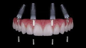 Implantatgetragener Zahnersatz