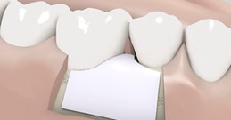 Verwendung von einer resorbierbaren Membran bei einem Knochendefekt.