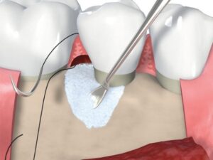Knochenersatzmaterialien zum Auffüllen des Knochendefektes, teilweise kombiniert mit GTR-Membranen.