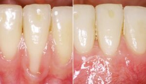 Rezessionsdeckung im Frontzahnbereich, durch Verwendung Bindegewebetransplantation und Envelope-Technik.