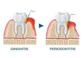 Vergleich von Gingivitis und Periodontitis.