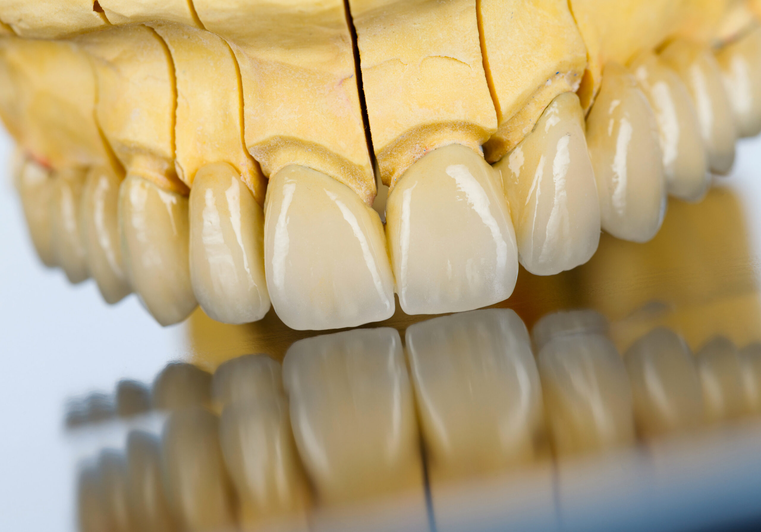 Zahnmodell mit keramischen Kronen aus der dentalen Prothetik.